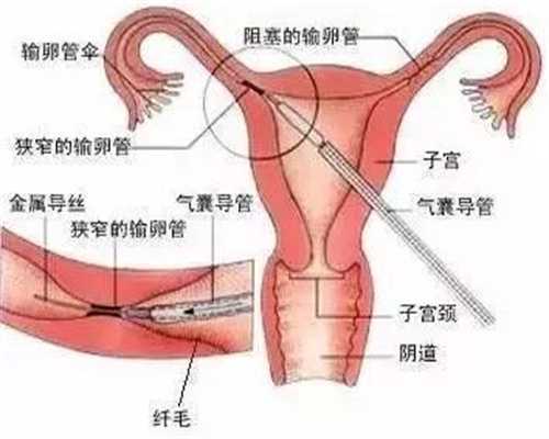 香港代孕商业化w：第三代试管婴儿移植后，怎么