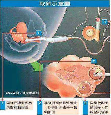 南京三代试管技术：如何实现优生优育？